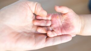 Bệnh tổ đỉa ở trẻ em